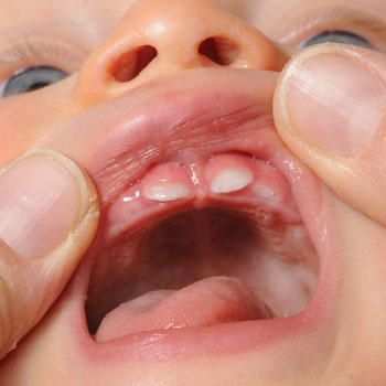 Erste Zähnchen erste Zähne Baby Kleinkind natürlich Hausmittel gegen Schmerz 10g 